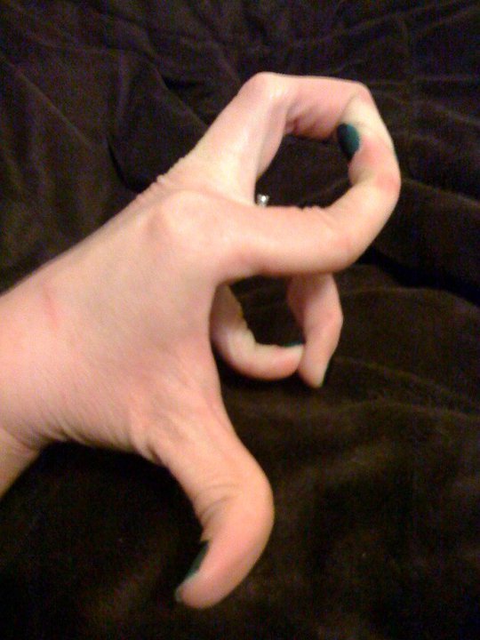 hypermobilefingers.jpg.453bb039e4c72b52ebf88aba922151b2.jpg